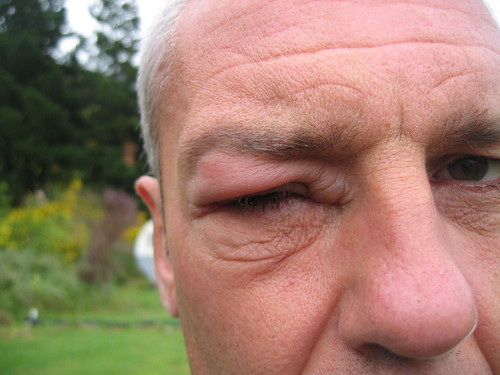 What happens when a mosquito bites your eyelid.