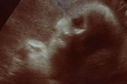 36 weeks - 9 months - Ultrasound rendition.