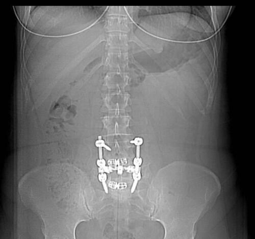 herniated lumbar disc. A repeat disc herniation was
