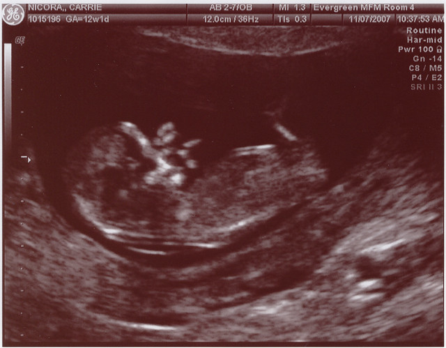 fetus at 6 weeks. fetus at 6 weeks. fetus at 6