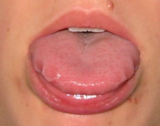 Swollen Tongue, Feb 18