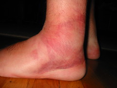 My Ankle