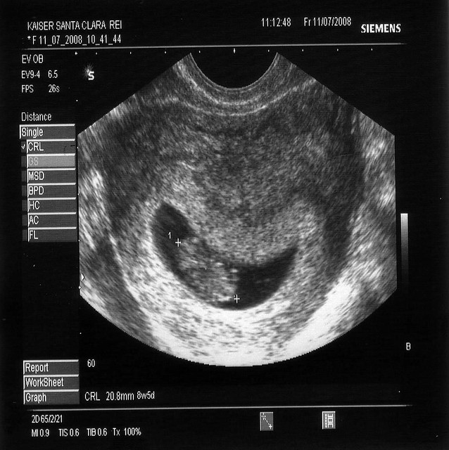 12 5 week ultrasound. 12 5 week ultrasound. months 1 2 3 weeks 4 5 6 7 8 9; months 1 2 3 weeks 4 5 6 7 8 9. cocky jeremy. Apr 2, 03:20 AM. AirDrop wasn#39;t on Preview 1 for me.