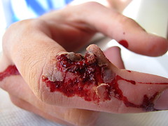 Nic's Injured Finger