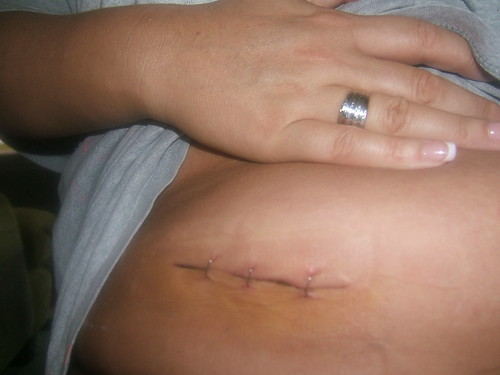 gallbladder surgery scars pictures. Stomach+surgery+scar