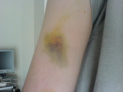 Bruise.JPG