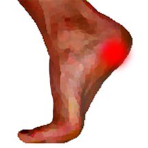 Heel Pain Area