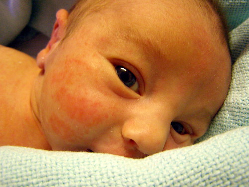 toddler heat rash pictures. fb27dc4a27 Toddler Rashes
