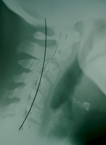 Cervical spine x-ray