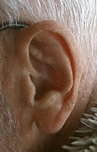 Ear Wart