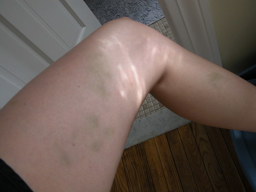 I need to find a culture where bruises are hot.