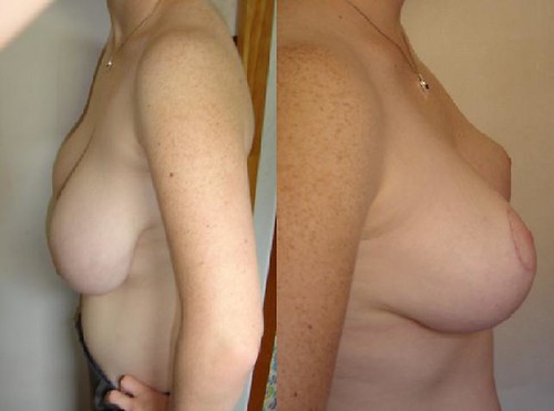 Areola Reduction Surgery. Quest for Reduction Surgery