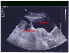 Embryos in my Uterus