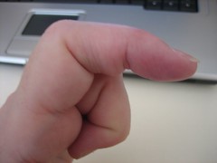 Finger needs rehabilitation
