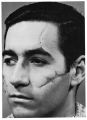 Dick Smith's Collodion Scars