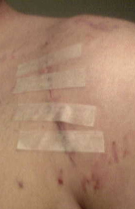 Incision scar after stitches removed