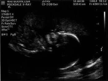 Ultrasound at 19 weeks