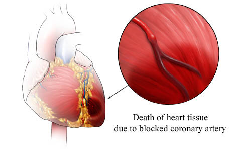 Female heart attack symptoms list