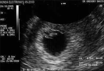 Ultrasound at 6 weeks