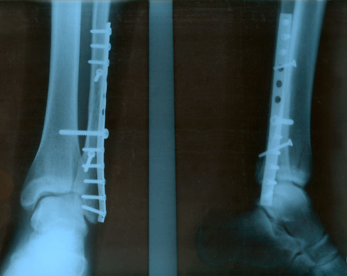 x-ray of ankle at lower leg