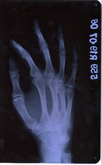 Right Hand X-Ray, Oblique