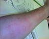 Allergy Test Results