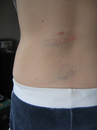 back_bruises2