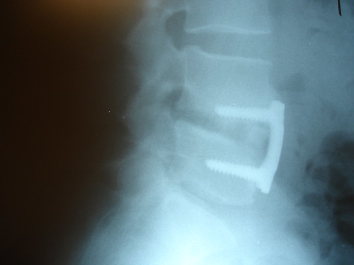 Operație de fuziune a discurilor vertebrale L5-L4