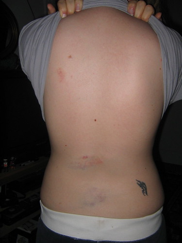 back_bruises1