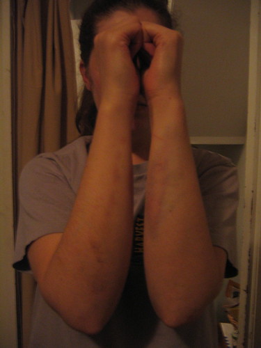 forearm_bruises