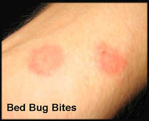 Bed Bugs Bites Pictures | Bed Bugs Bites | Get Rid Of Bedbugs