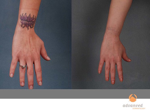 Laser Tattoo Removal in Chicago, IL | Advanced Dermatology