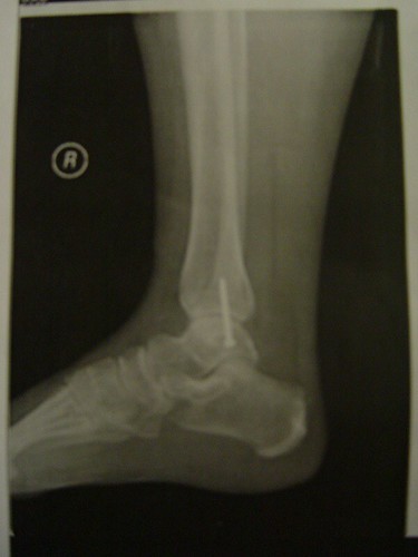 Ankle 1