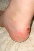 My blistered foot!