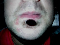17mm Labret stretched