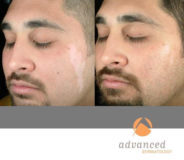 xtrac-laser-therapy-treatment-chicago-il-advanced-dermatology